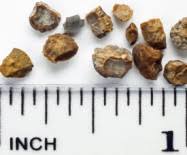 Answers To 4 Questions You May Have About Kidney Stones Kidney Stones Kidney Stones Symptoms Kidney Stone Diet