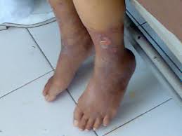 Diabetes With Peripheral Vascular Disease Icd 10 Diabeteswalls