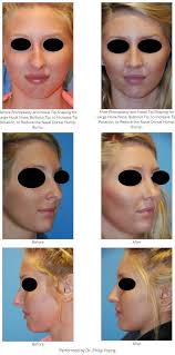 If your nose hairs are stubbornly making their way out of your nose for the whole world to see, then perhaps it's time to learn how to get rid of nose hair. Before After Rhinoplasty And Nasal Tip Shaping For Large Hook Nose Bulbous Tip To Increase Tip Rotati Rhinoplasty Before And After Rhinoplasty Face Surgery