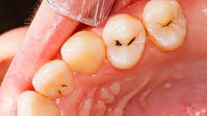 If the damage is more extensive, you may require a crown. Finding The Best Material For Filling A Tooth Cavity West Hollywood Holistic And Cosmetic Dental Care