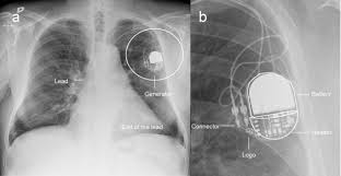 Here we distinguish between pacemakers and aicds and offer clues to identifying the implanted device. Pacemakers And Implantable Cardioverter Defibrillators Unknown To Chest Radiography Review Complications And Systematic Reading European Journal Of Radiology