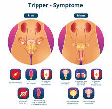 Gonorrhoe Tripper Ursachen Symptome Behandlung