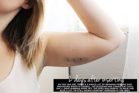 Implant insertion involves numbing the upper arm area and using a tool to insert the device into the arm, which may result in achiness and slight bruising. Aubrey Kinch My New Implant Birth Control