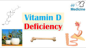 Severe vitamin d deficiency can also lead to other diseases. Vitamin D Deficiency Introduction Absorption Metabolism Purpose Of Vit D Causes Of Deficiency Youtube