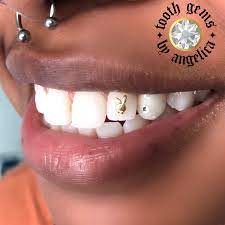 Pin On Tooth Gems