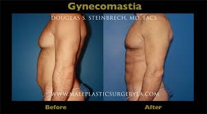How much does male breast reduction cost? Gynecomastia Surgery Cost In Los Angeles Gynecomastia Treatment Costmale Plastic Surgery Los Angeles
