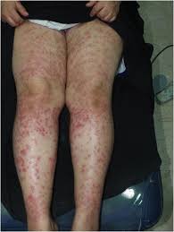Purpura is common in older people. Purpura Induced By Laser Hair Removal A Case Report Journal Of Medical Case Reports Full Text