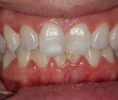 Specially formulated with baking soda to give you a noticeably whiter, brighter smile. Sunshine Smiles Of Orange County Blog How To Get Rid Of White Spots On Your Front Teeth Easily And Pain Free