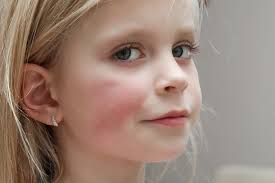 Image result for red rash face