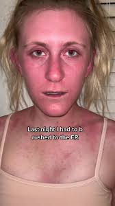 Anaphylactic shock is NO JOKE. #allergicreaction #hospital #epipen #c...