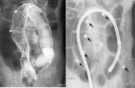 Image result for Sigmoid Volvulus