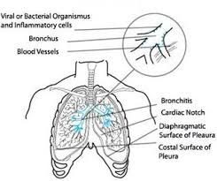 Image result for Acute Bronchitis