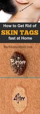 Best Skin Tags Removal Home Remedies How To Get Rid Of Skin Tag Fast At Home Skin Tag Removal Skin Tag Skin Tags Home Remedies