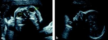 Trimester wird organscreening genannt und soll zwischen der 18. Organscreening 18 24 Schwangerschaftswoche Springerlink