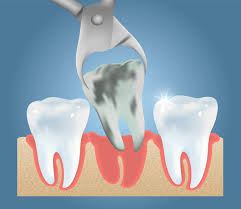 Common signs that you need to remove wisdom teeth include: What Is Wisdom Teeth When Do You Need To Take Appropriate Steps Wisdom Teeth Removal Emergency Dentist Wisdom Teeth