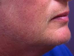 Thus, they can make the skin clearer, reduce facial hair, and. Hirsutism Dermnet Nz