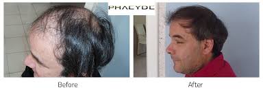 Kálloy molnár péter eddig megjelent könyvei online kedvezménnyel, kálloy molnár péter akciós könyvei, előrendelhető könyvek. Hair Transplant Kalloy Molnar Peter 4500 Before After