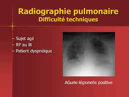 Selon les plaignants, organigram a omis de mettre en place des. Ppt Pneumopathies Communautaires Powerpoint Presentation Free Download Id 363802