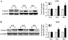 85 db @ 10 feet. Transgelin Overexpression In Lung Adenocarcinoma Is Associated With Tumor Progression