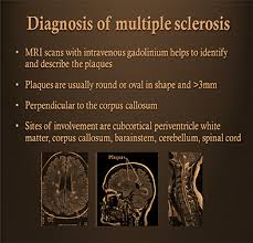 The cause of multiple sclerosis is unknown. Multiple Sclerosis Symptoms Book Chapter Iopscience