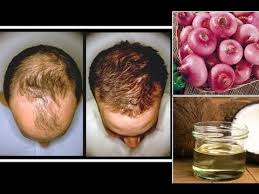 Thirdly, it makes for an amazing hot oil treatment—massaging the oil into your roots will help your scalp drink up all of the nutrients and help promote hair growth. Is Onion Juice A Good Remedy For Hair Fall Quora