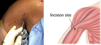 Image result for Biceps Tendon Injection
