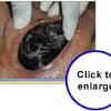 Effacement and dilation are direct results of effective uterine contractions. 1