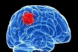 Brain tumors in children make up about 15% of pediatric cancers. Brain Cancers Acco