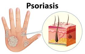 Image result for koebner phenomenon psoriasis