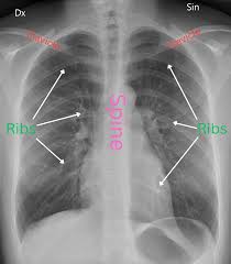 Image result for Chest XRay