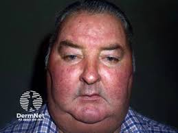 Image result for Systemic Corticosteroid