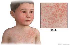 Image result for Rubella