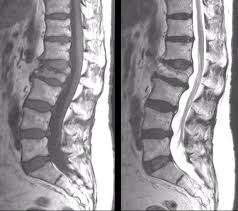 Image result for Vertebral Compression Fracture
