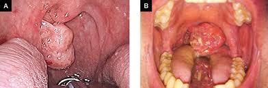 It is important to ask oneself, what does oral cancer therefore, individuals with questionable lesions on their cheeks should ask a dentist what oral cancer looks like in the mouth on the cheek? Hpv And Throat Cancers Ent Specialist Singapore