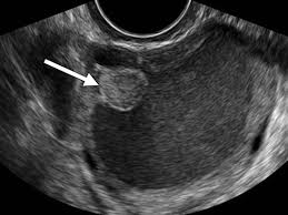 Endometriosis and ovarian cancer are linked, but the relationship isn't straight cause and effect. Findings Of Pelvic Endometriosis At Transvaginal Us Mr Imaging And Laparoscopy Radiographics