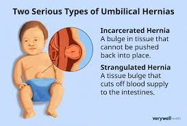 Image result for stomach hernia symptoms