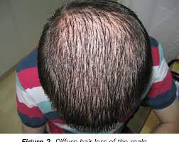 Hiv hair loss is not usually a direct result of the having the disease. Diffuse Hair Loss In Secondary Syphilis In Hiv Positive Man Case Report Semantic Scholar