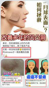 烦恼多年的凹凸洞终于 到改善啦 开心 开心 之前用过无数产品都没有效 charmzdna 才用一瓶就看到效果痘疤印 痘疤印 不要再担心 痘疤印 生痘痘涂一涂