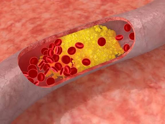Bad cholesterol is a silent killer heart attack can come anytime without any warning signs | साइलेंट किलर है बैड कोलेस्ट्रॉल, आपको महसूस भी नहीं होगा और पड़ जाएगा दिल का दौरा!