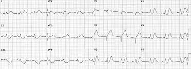 Check spelling or type a new query. De Winter T Wave Litfl Ecg Library Diagnosis
