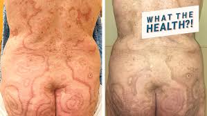 If the diagnosis is delayed, the cancer can spread to distant sites. W H A T D O E S I N F L A M M A T O R Y B R E A S T C A N C E R L O O K L I K E Zonealarm Results