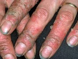 Image result for dermatitis contacta allergica
