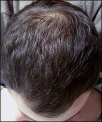 L'alopécie androgénétique est la forme la plus répandue de perte de cheveux chez les femmes. Chute De Cheveux Et Perte De Cheveux Alopecie Traitement