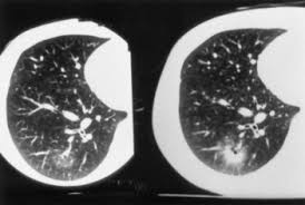 Endometriosis is more common in women who are having fertility issues, but it does not necessarily cause infertility. A Case Of Endobronchial Endometriosis Treated By Subsegmentectomy Chest