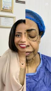 #facelift #شد_الوجه , أ. د/أشرف كامل استشاري جراحات التجميلDr.ashraf Kamel  Consultant Plastic Surgeon‎للتواصل علي الخاص dm او +201223652408‎من خارج  مصر International ...