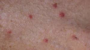Image result for scabies human bites