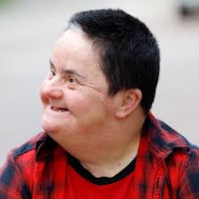 Down syndrome (ds), also known as trisomy 21, is the most common genetic disorder causing intellectual disability and the most frequently occurring human chromosomal syndrome. Alzheimer S Disease In People With Down Syndrome National Institute On Aging