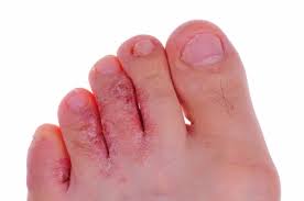 Hongos En Los Pies Que Son Y Que Podemos Hacer Familia Y Salud