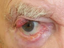 Poor merkel cell carcinoma (mcc) is an increasingly common neuroendocrine skin cancer that is associated with. Merkel Cell Carcinoma Dermnet Nz