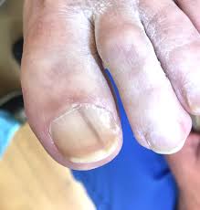 They include toenail fungus, injury or trauma to the nail, and toenail cancer. Black Longitudinal Toenail Line Should I Worry Compleet Feet